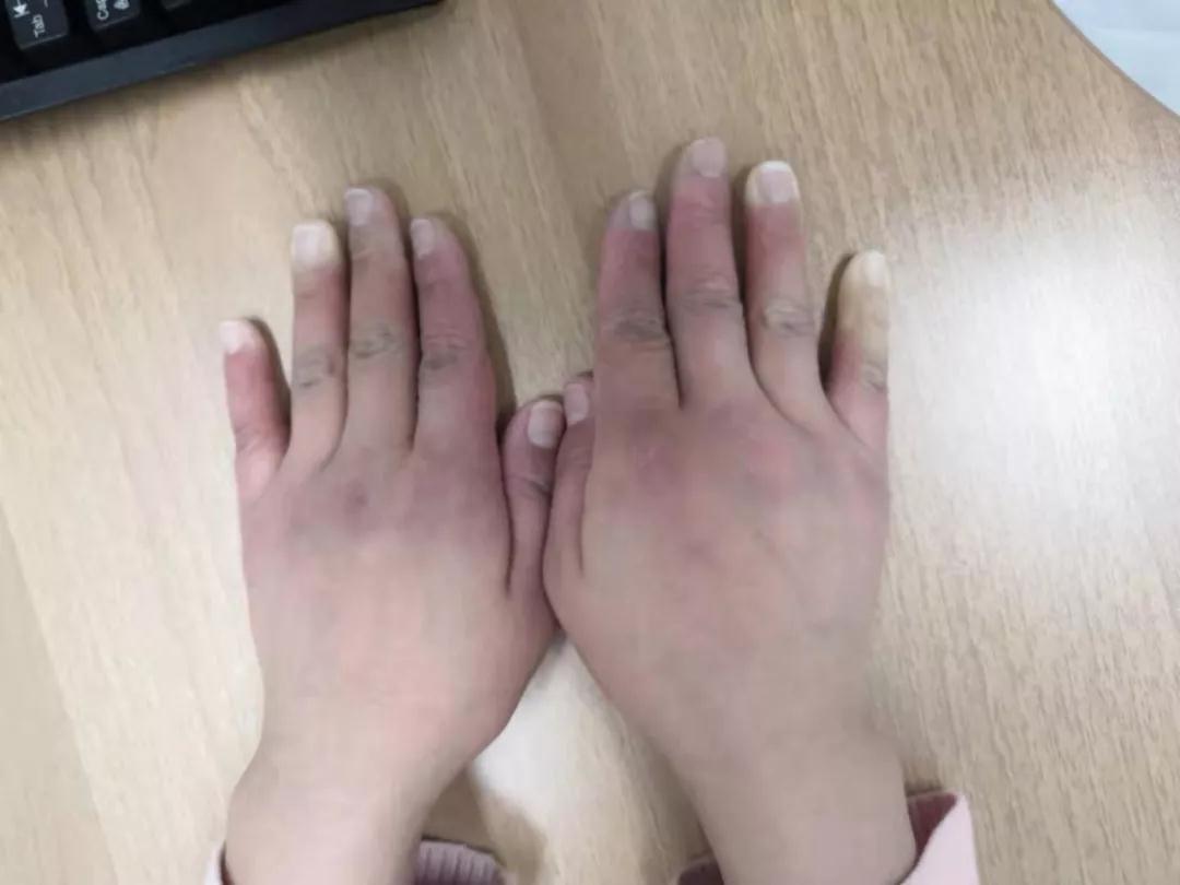 “手指、腳趾發(fā)白、發(fā)紫……”這些“小毛病”千萬別大意