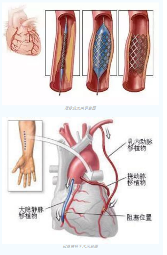 魚與熊掌不可兼得？冠脈雜交手術(shù)一站式解決問題