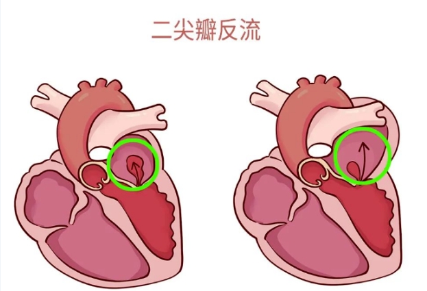 體檢報(bào)告里的心臟瓣膜返流，你讀懂了嗎？